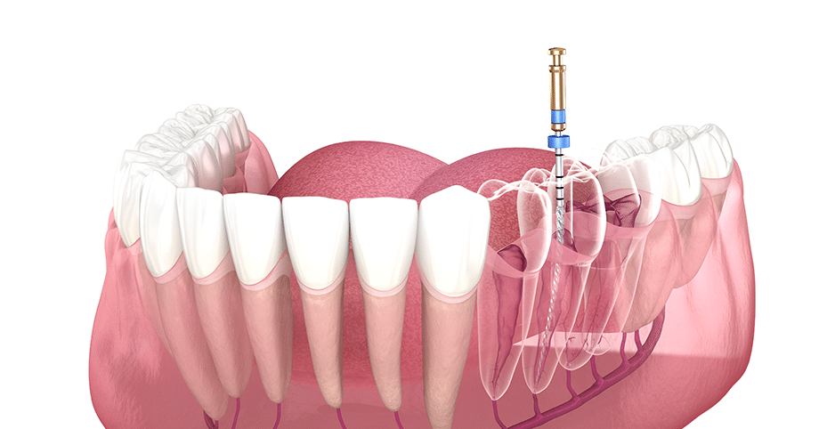 Root Canal Treatment